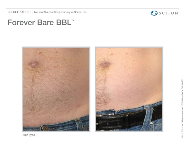 Forever Body BBL Skin Type Before And After | Evolve Aesthetics in Waterloo, IA