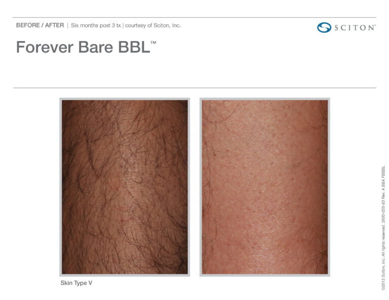 Forever Body BBL Skin Type | Evolve Aesthetics in Waterloo, IA