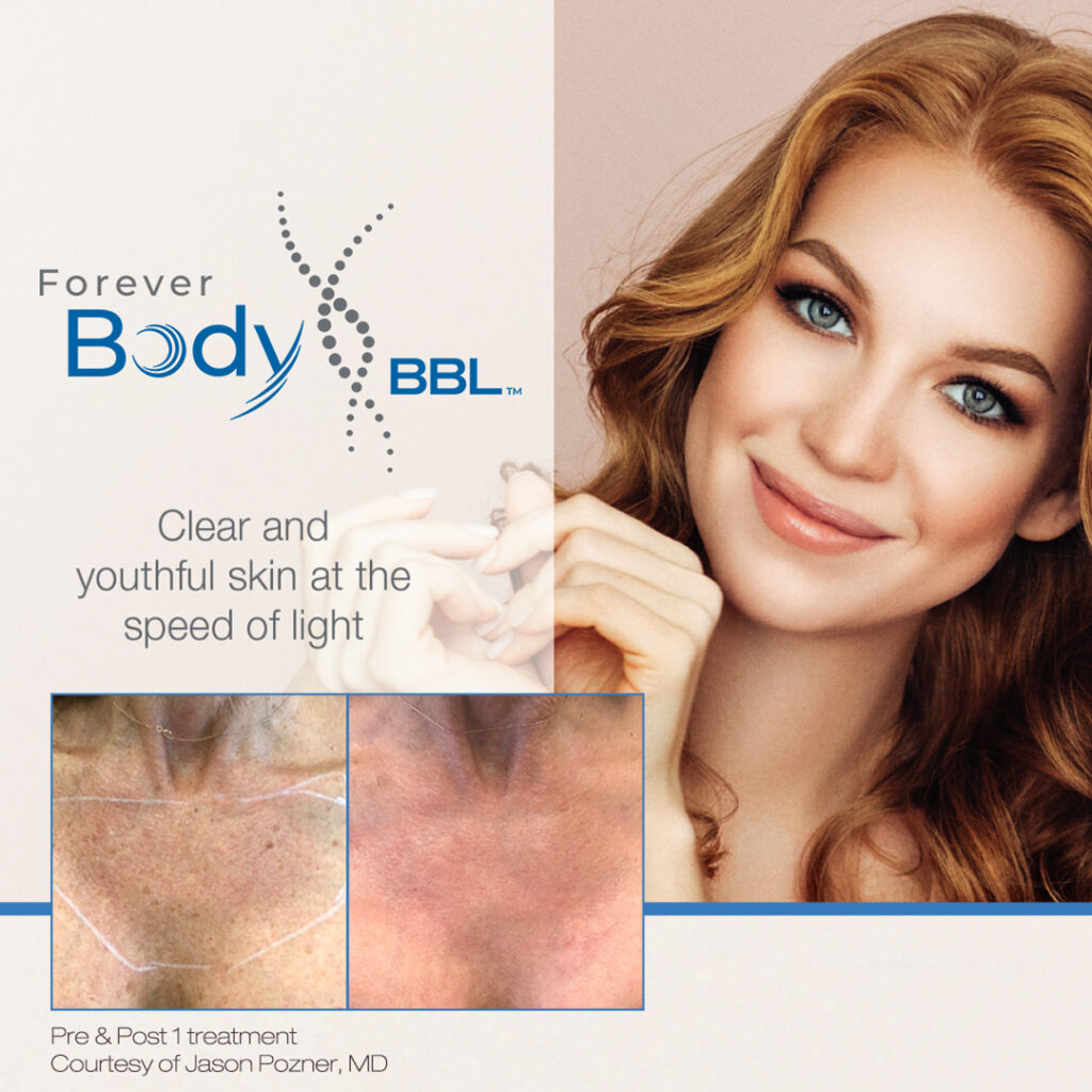 Forever Clear BBL Clear And Youthful Skin At The Speed Of Light | Evolve Aesthetics in Waterloo, IA