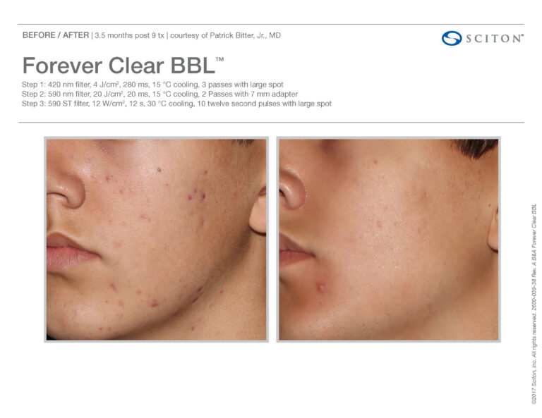 Forever Clear BBL Spot Treatment Before and After Photos | Evolve Aesthetics and Regenerative Medicine in Waterloo, IA