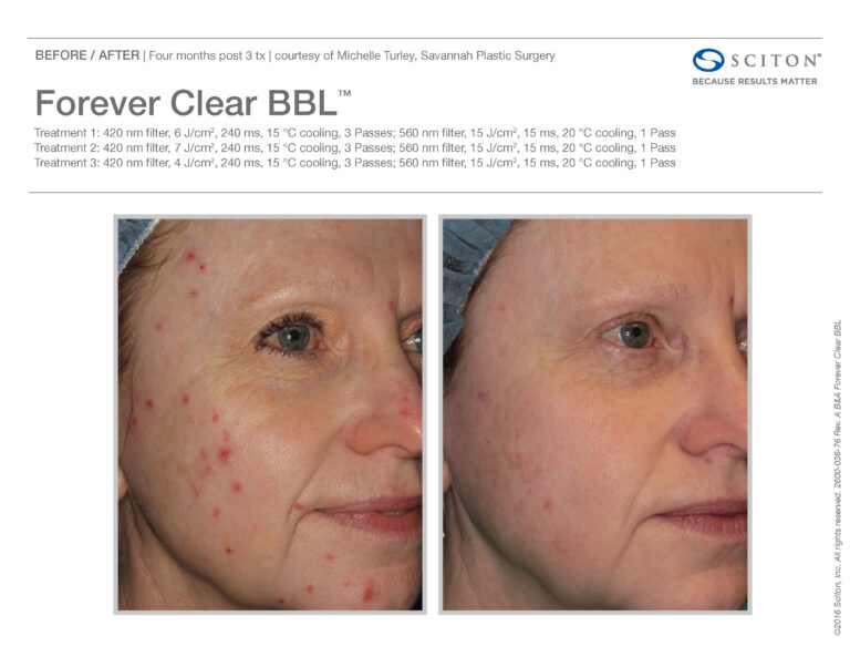 Forever Clear BBL Acne Treatment Before and After Photos | Evolve Aesthetics and Regenerative Medicine in Waterloo, IA