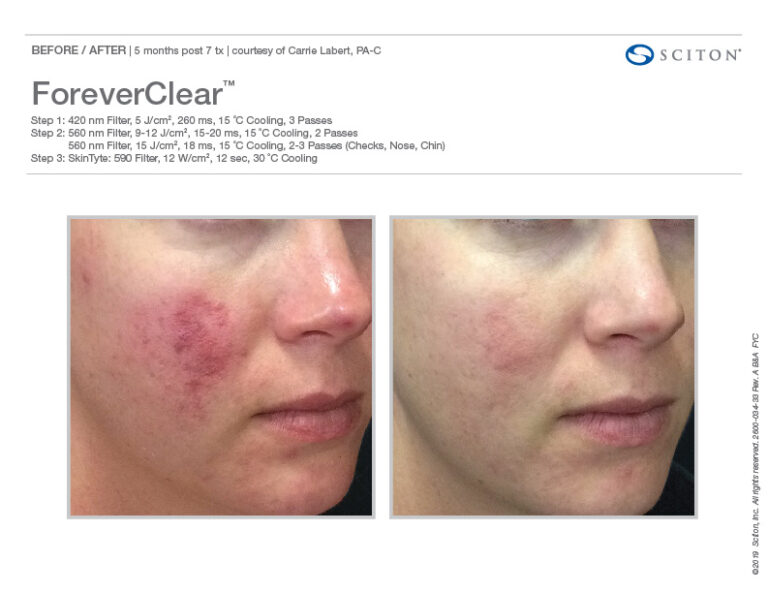 Forever Clear BBL Before and After Treatment | Evolve Aesthetics and Regenerative Medicine in Waterloo, IA