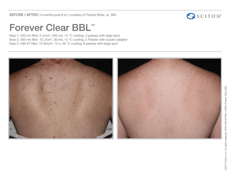Forever Clear BBL Body Acne Treatment Before and After Photos | Evolve Aesthetics and Regenerative Medicine in Waterloo, IA
