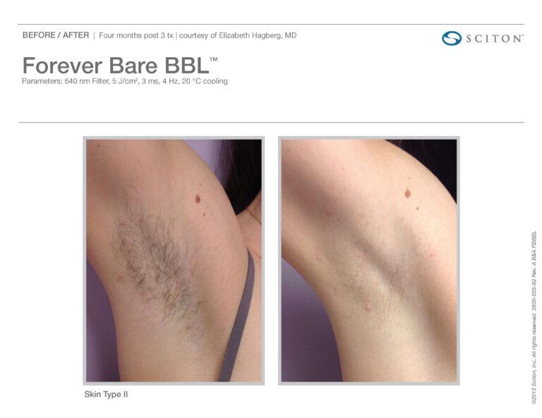 Forever Body BBL Skin Type Images | Evolve Aesthetics in Waterloo, IA