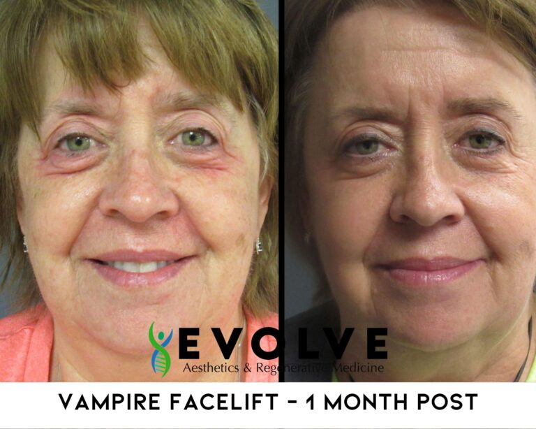 Vampire Facelift Before and After Photos | Evolve Aesthetics and Regenerative Medicine in Waterloo, IA
