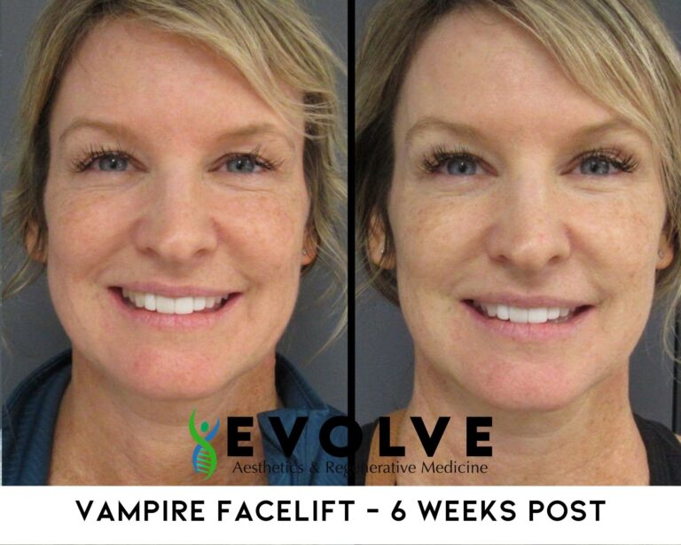 Vampire Facelift Before and After Photos | Evolve Aesthetics and Regenerative Medicine in Waterloo, IA