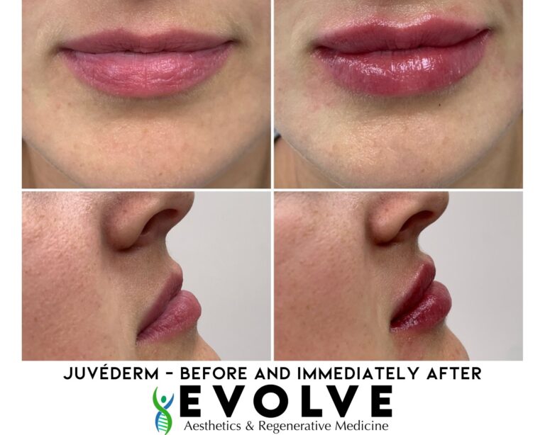Juvederm Lip Filler Before and After Photos | Evolve Aesthetics and Regenerative Medicine in Waterloo, IA