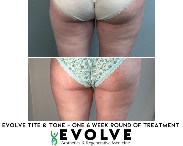Evolve Tite and Tone Body Contouring and Fat Reduction Before and After Photos | Evolve Aesthetics and Regenerative Medicine in Waterloo, IA