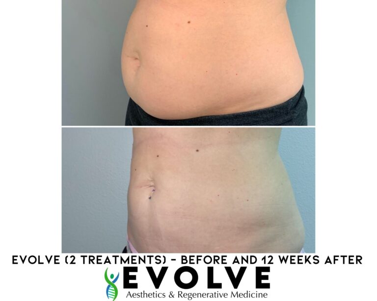 Evolve Stomach Fat Removal Treatment Before and After Photos | Evolve Aesthetics and Regenerative Medicine in Waterloo, IA