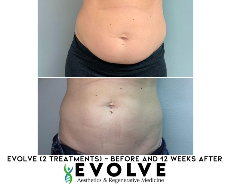Evolve Body Contouring Treatment Before and After Photos | Evolve Aesthetics and Regenerative Medicine in Waterloo, IA