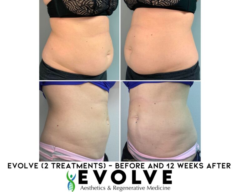 Evolve Fat Removal Treatment Before and After Photos | Evolve Aesthetics and Regenerative Medicine in Waterloo, IA