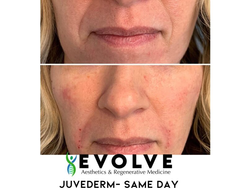 Juvederm Before and After Photos | Evolve Aesthetics and Regenerative Medicine in Waterloo, IA