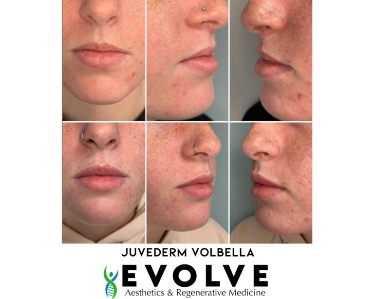 Juvederm and Volbella Lip Filler Before and After Photos | Evolve Aesthetics and Regenerative Medicine in Waterloo, IA