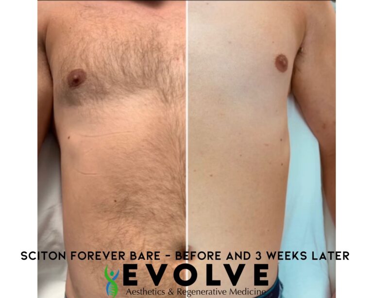 Male Sciton Forever Bare Stomach Laser Hair Removal Treatment Before and After Photos | Evolve Aesthetics and Regenerative Medicine in Waterloo, IA