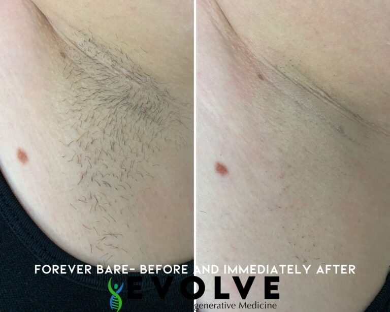 Forever Bare Underarms Laser Hair Removal Before and After Photos | Evolve Aesthetics and Regenerative Medicine in Waterloo, IA