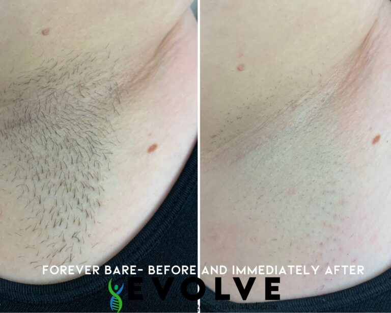 Forever Bare Underarms Laser Hair Removal Before and After Photos | Evolve Aesthetics and Regenerative Medicine in Waterloo, IA