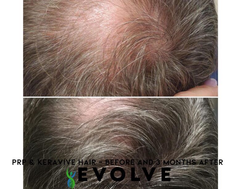 PRP and Keravive Hair Restoration Treatment Before and After Photos | Evolve Aesthetics and Regenerative Medicine in Waterloo, IA