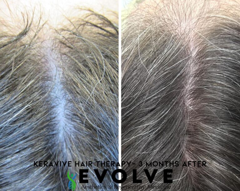 Keravive Hair Therapy Before and After Photos | Evolve Aesthetics and Regenerative Medicine in Waterloo, IA