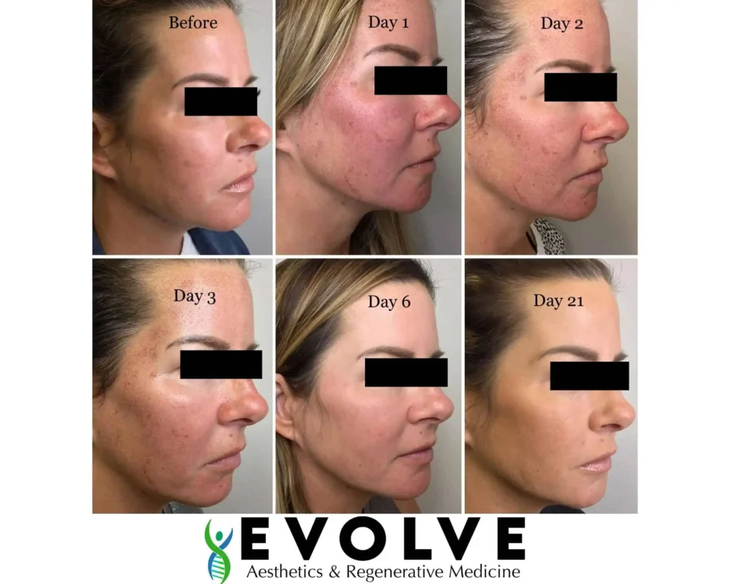 BBL HALO Before and After by Evolve Aesthetics in Waterloo IA