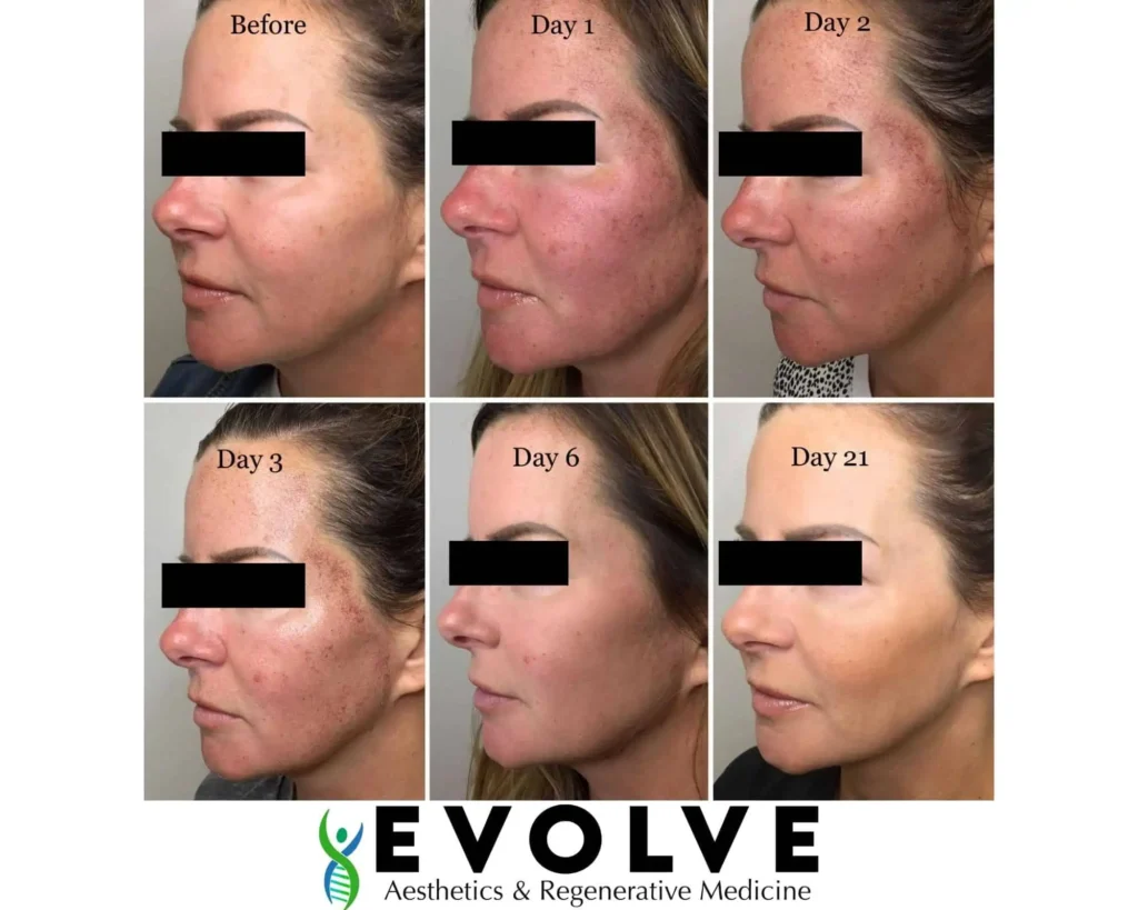 BBL HALO Before and After by Evolve Aesthetics in Waterloo IA