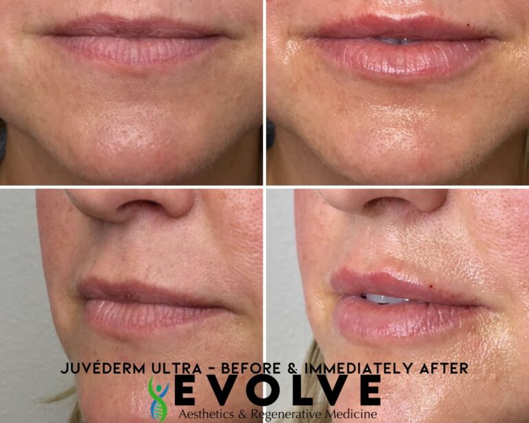 Juvederm Ultra Treatment Before and After Photos | Evolve Aesthetics and Regenerative Medicine in Waterloo, IA