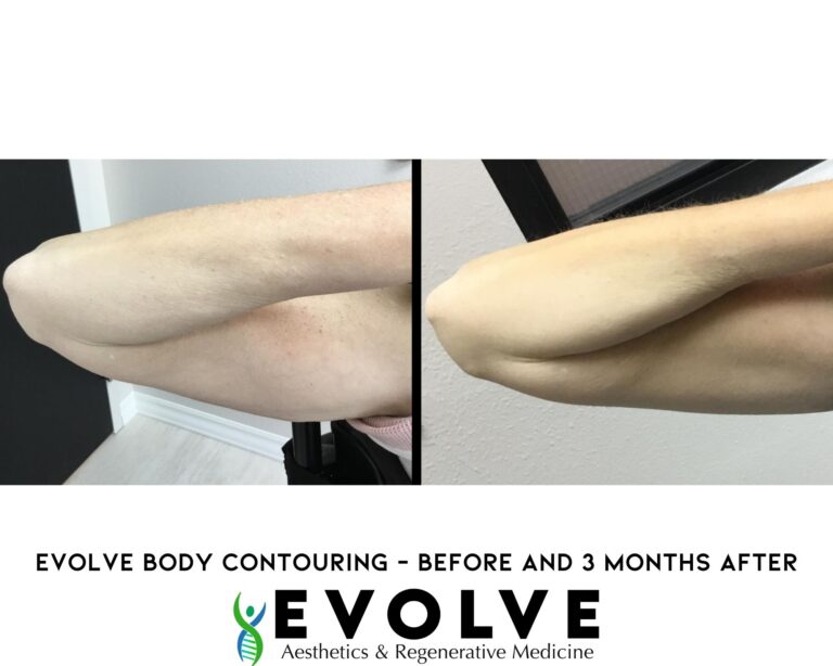 Understanding Body Contouring with Evolve Transform X - Astra Medicare