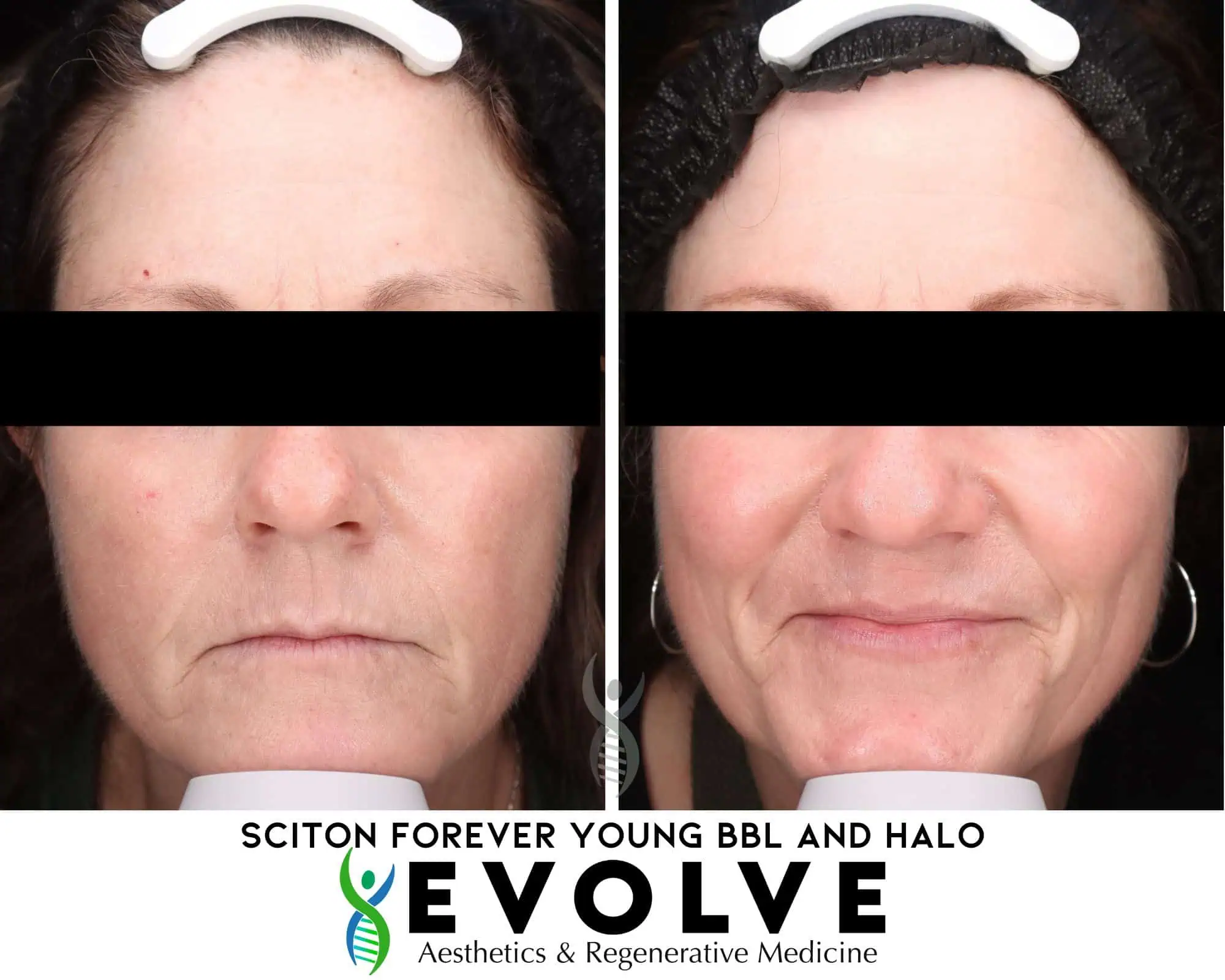 Sciton HALO™ Before & After Treatment Images in Waterloo IA