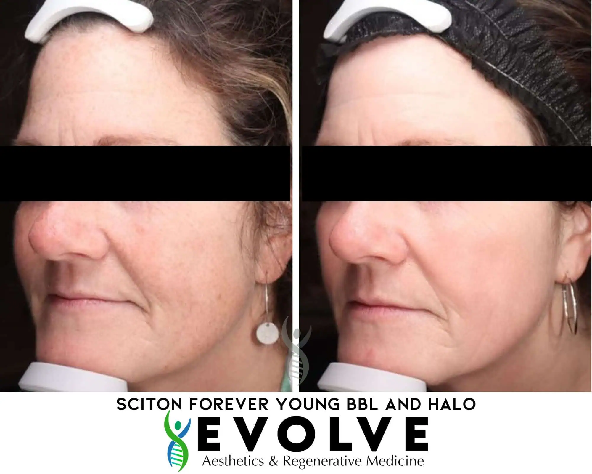 Sciton HALO™ Before & After Treatment Images in Waterloo IA