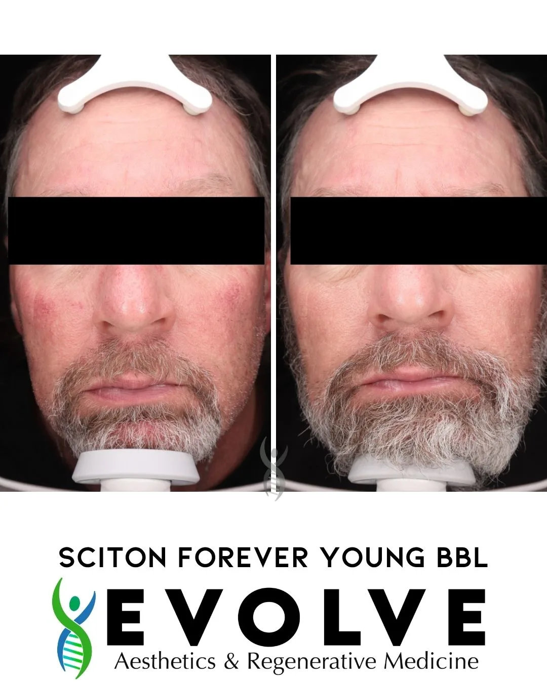 ScitonBBL-evolve-aesthetics-medicine-waterloo-IA (2)