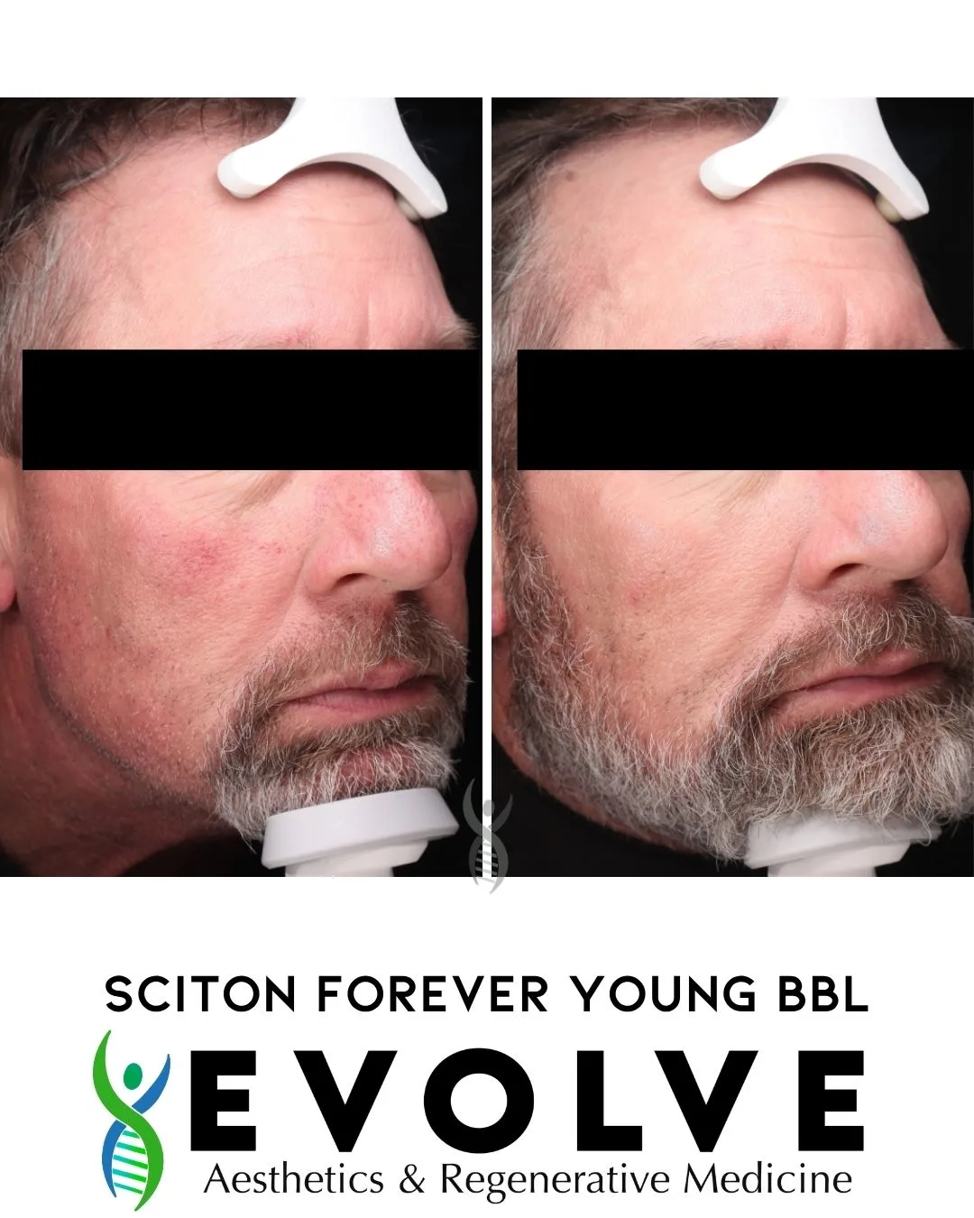ScitonBBL-evolve-aesthetics-medicine-waterloo-IA (3)