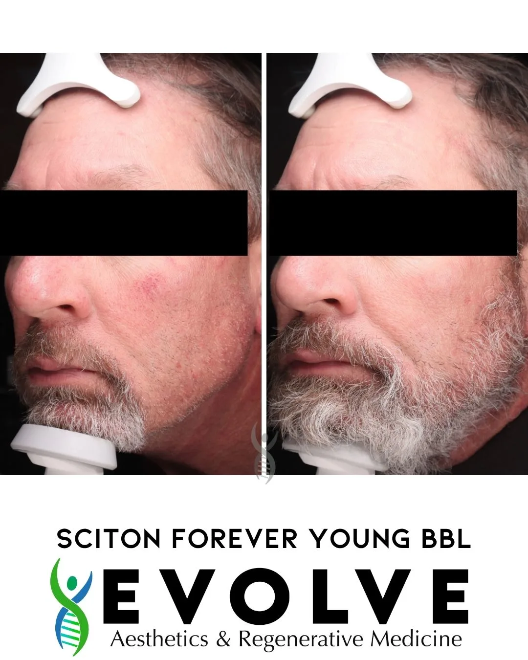 ScitonBBL-evolve-aesthetics-medicine-waterloo-IA