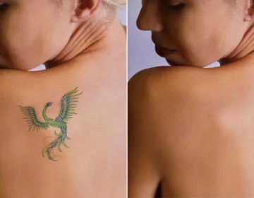 Tatt2Away Before and After by Evolve Aesthetics in Waterloo IA