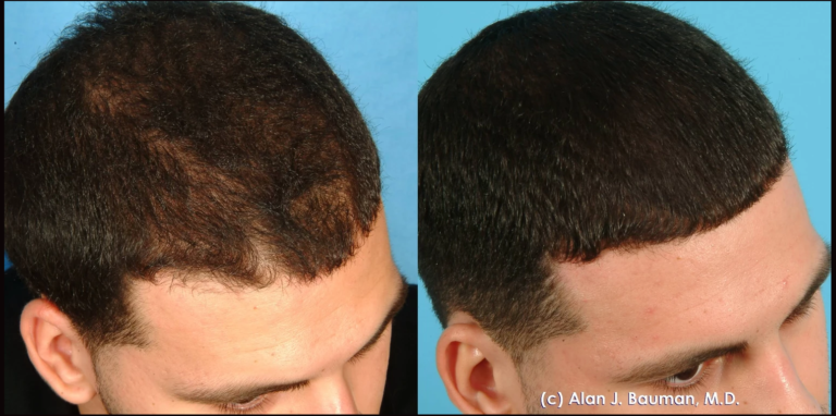 PRP Hair Restoration - Evolve Aesthetics and Regenerative Medicine